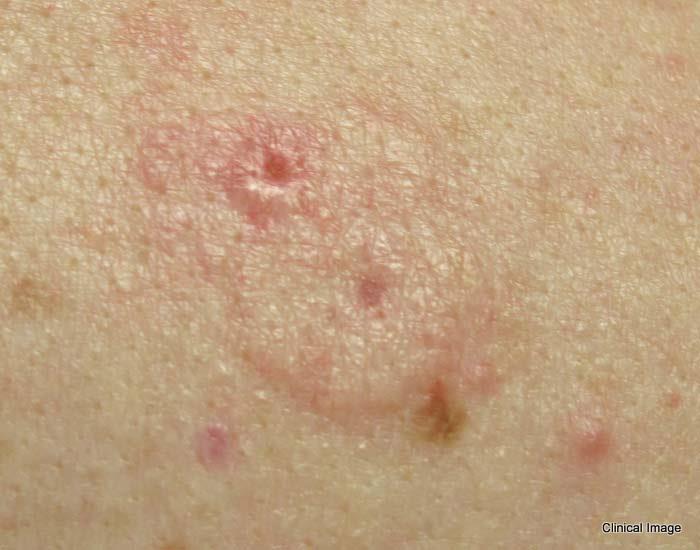 Five Warning Signs of Basal Cell Carcinoma - SkinCancer.org